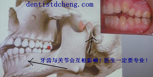后牙锁合(隐藏的危害)-严重病例欣赏—程德盛牙齿整形